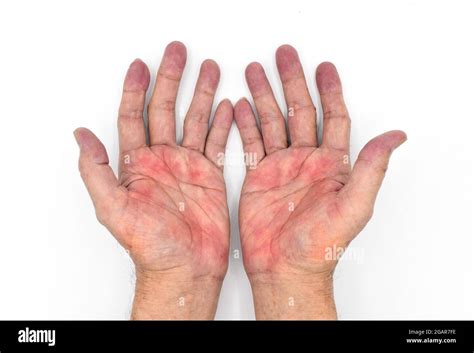 Palmar Erythema Often Called Liver Palms In Both Hands Of Southeast