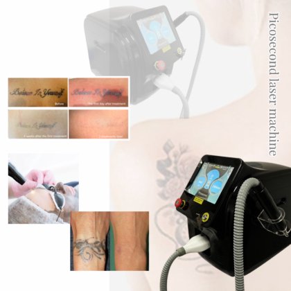 Picosecond Pico Laser Tattoo Removal Q Switch Laser Tattoos Removal