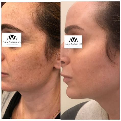 Picosure The Dark Spot Removal Treatment For All Skin Types Anna