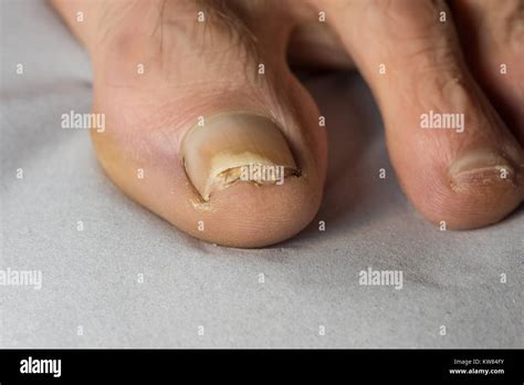 Pictures Of Toenail Trauma