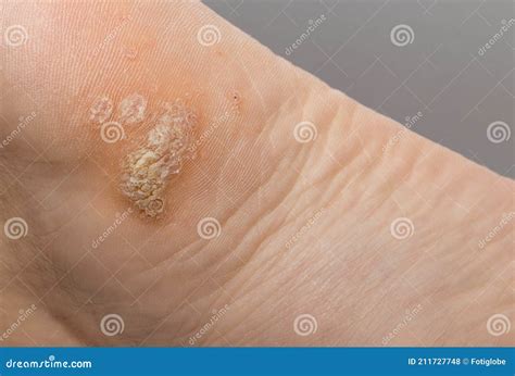 Plantar Wart Close Up On The Bottom Of A Female Foot Heel Caused By The