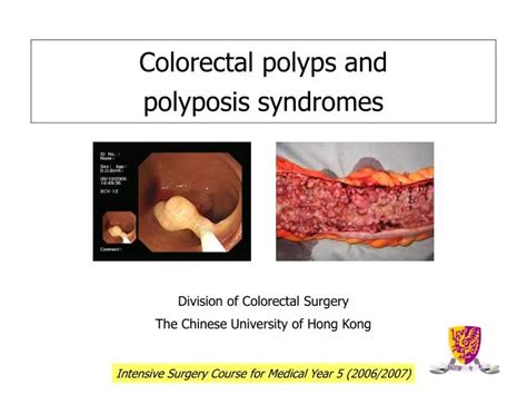 Ppt Colorectal Polyps And Polyposis Syndromes Powerpoint Presentation