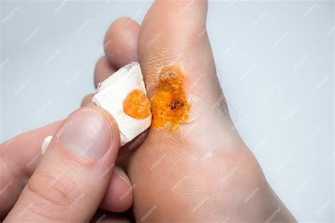 Premium Photo Contagious Skin Illness On Foot Medical Treatment