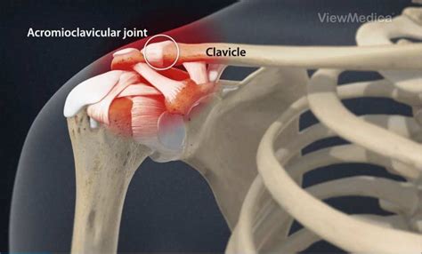 Prestige Pain Centers Intraarticular Steroid Injections