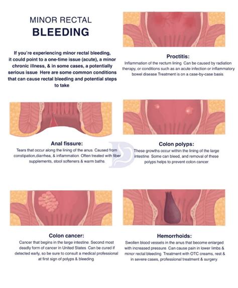 Prevention Of Colon Polyps And Cancer Digestive And Liver Health