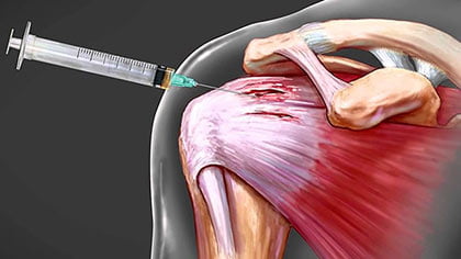 Shoulder Injection In Nyc Professional Community Article By Pain