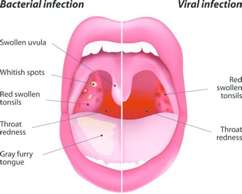 Sore Throat Disease Reference Guide Drugs Com