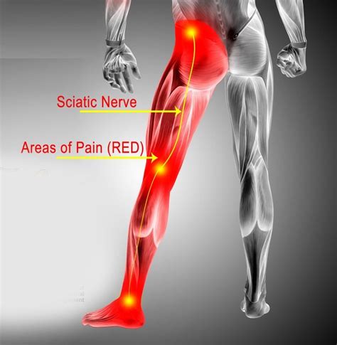 Symptoms Of Sciatica Buttock