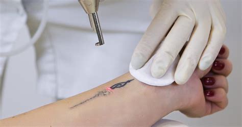 Tattoo Removal Reading Laser Tattoo Removal Reading Dr Bk