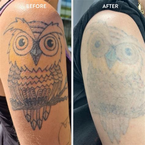 Tattoo Removal Uk Certified Laser Removal In Manchester