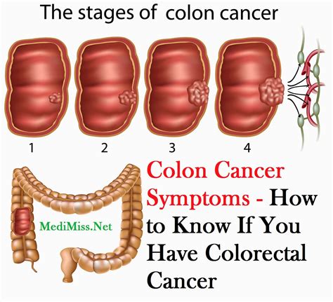 The Difference Between Colon Polyps And Colon Cancer