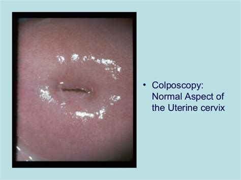 The Normal Cervix And Colposcopic Appearance Chapter 2 Colposcopy