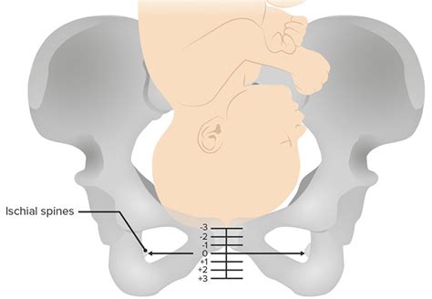 The Ultimate 10Step Guide To Handling Cephalopelvic Disproportion Today