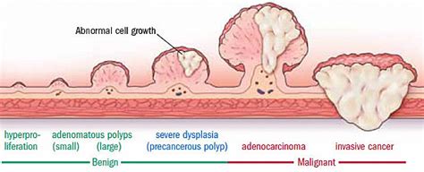 They Found Colon Polyps Now What Harvard Health