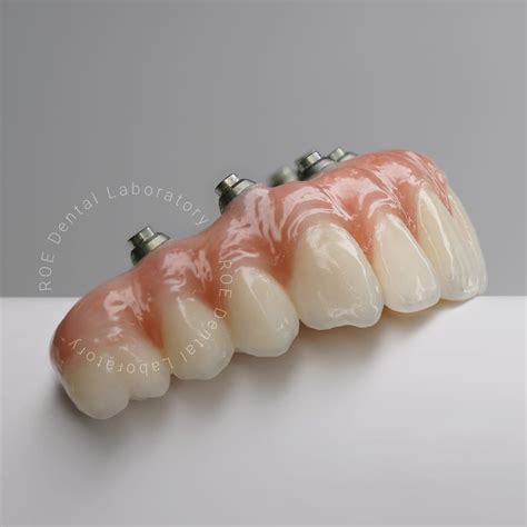 Tlz Ib Monolithic Implant Bridge Roe Dental Laboratory