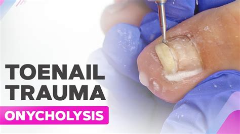 Toenail Trauma Onycholysis Cleanup Youtube