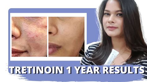 Tretinoin Before And After 1 Year Tretinoin Experience And Review