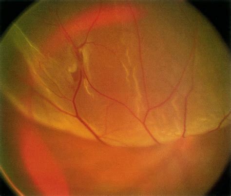 Ultimate Guide: 7 Tips To Make Retinal Detachment A Thing Of The Past