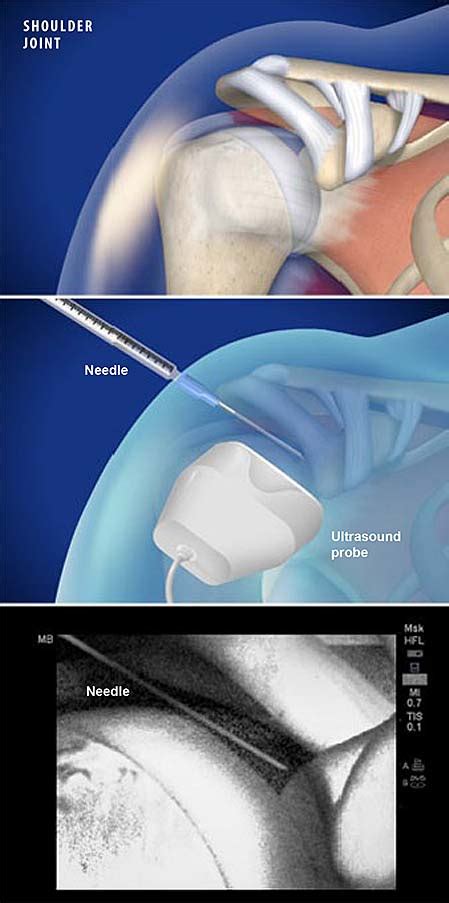 Ultrasound Guided Injection For Shoulder Pain Central Coast