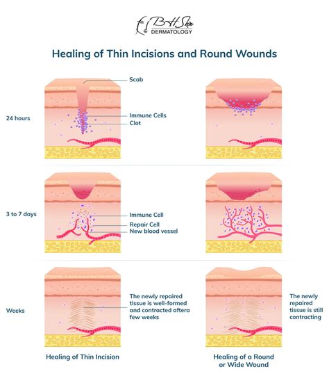 Wart Removal Recovery Complete Guide On Healing Process And Aftercare Tips