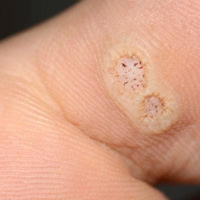 Warts Difficult To Eradicate In Immunocompromised Children Mdedge