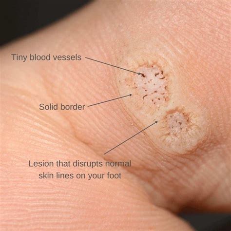 Warts On Feet Pictures Treatment Causes Contagious