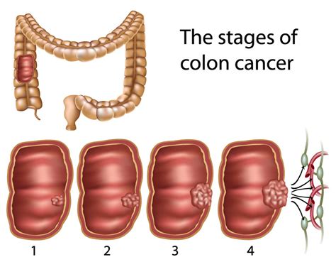 What Are Colon Polyps And Are All Polyps Cancerous Colon Rectal