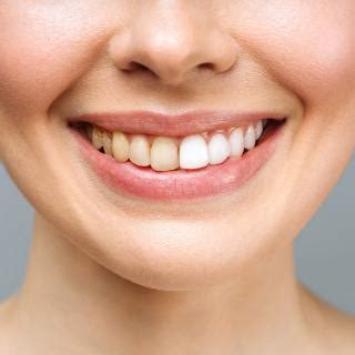 What Causes Discolored Teeth And Is There Any Way To Cure Or Prevent