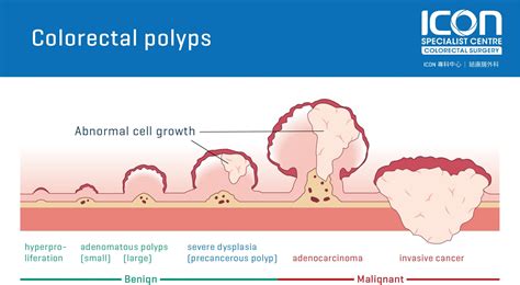 What Is Colon Polyps